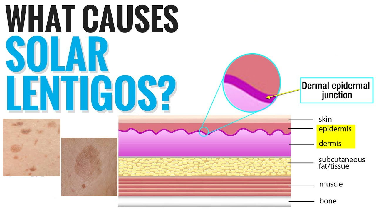 孚美达“氟轻松氢醌维A酸乳膏”能用于老年斑治疗吗？