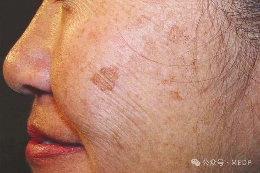 老年斑、晒斑、日光性雀斑是一回事吗？
